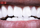 Everyone knows that too much sugar can damage teeth. But new research into the oral microbiome diet suggests that protecting your mouth may involve more than simply avoiding sweets and brushing regularly. What you put on your plate can influence the complex community of microorganisms living inside your mouth.
